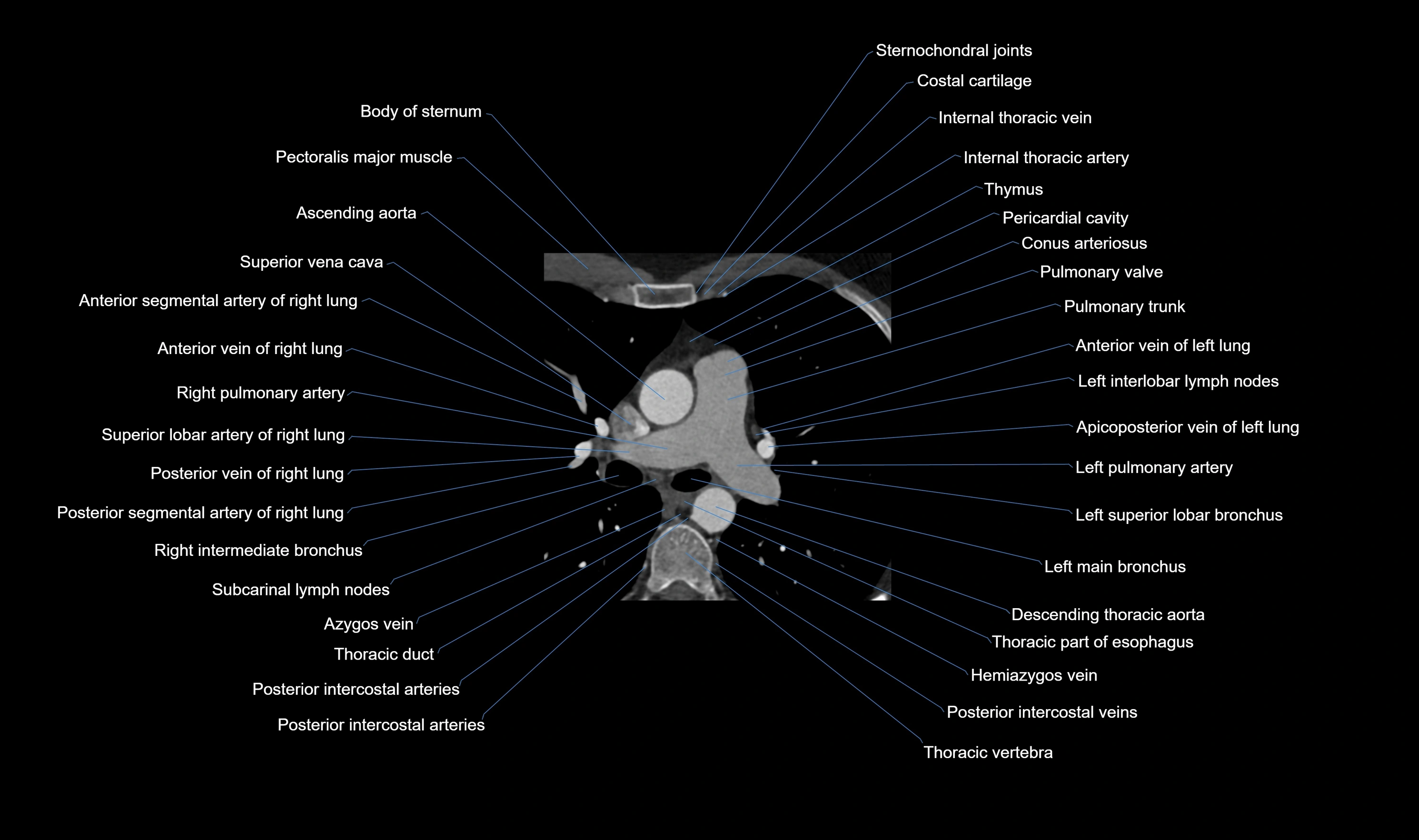 CT heart (coronary angiogram) axial view cross sectional anatomy labelled radiology image-00011.webp